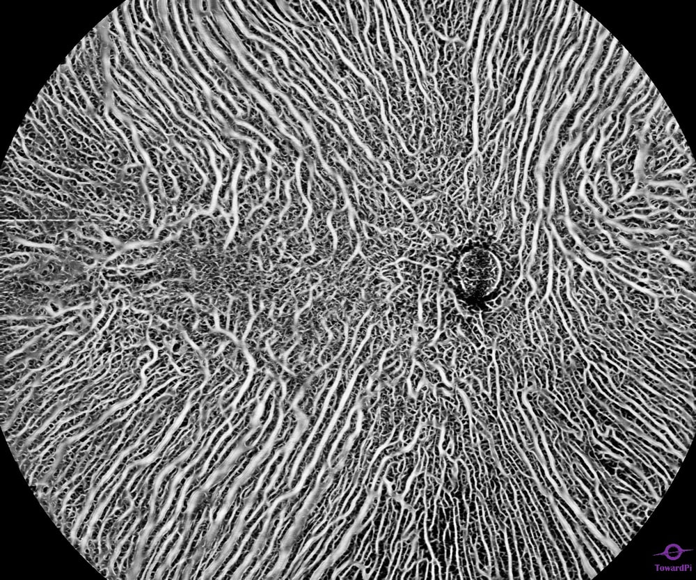 Choroid