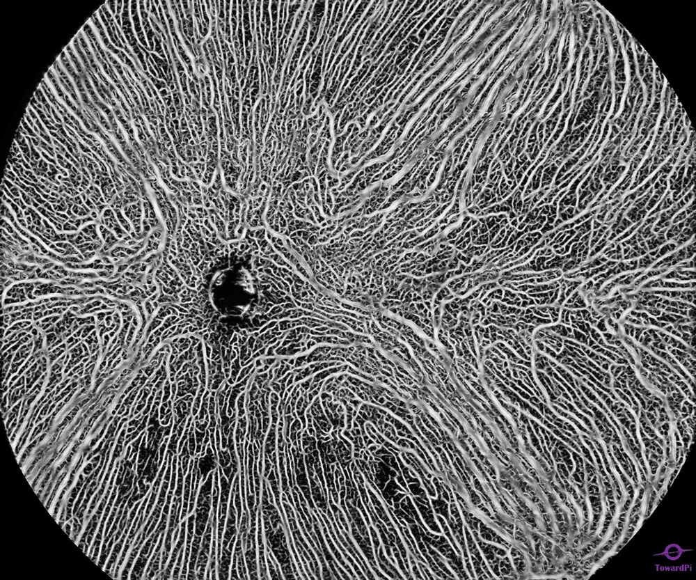 Choroid