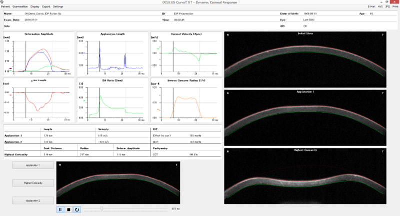 Dynamic Corneal Response