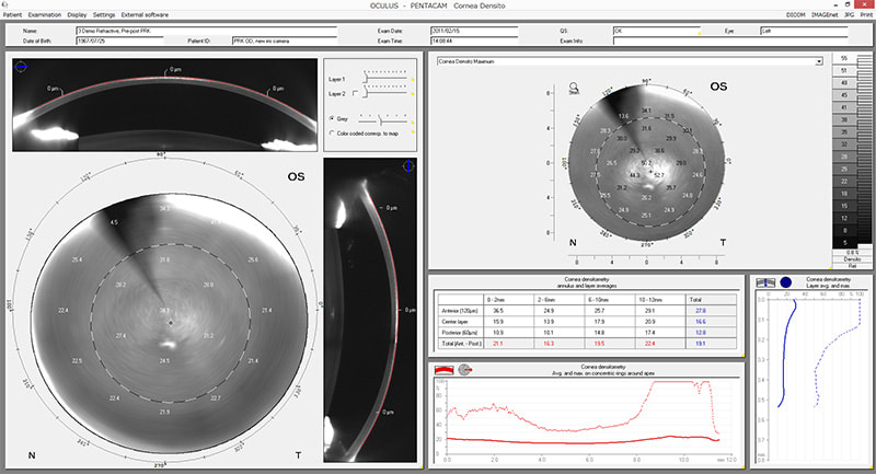 Corneal Optical Densitometry