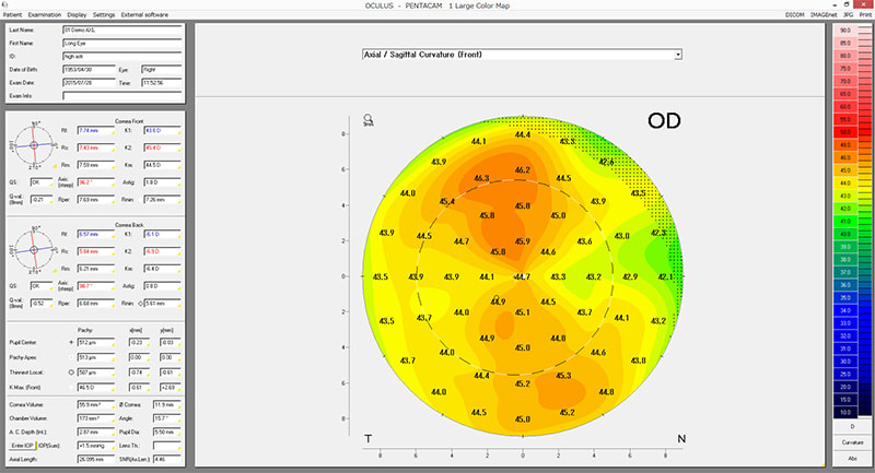 角膜前後面のトポグラフマップ