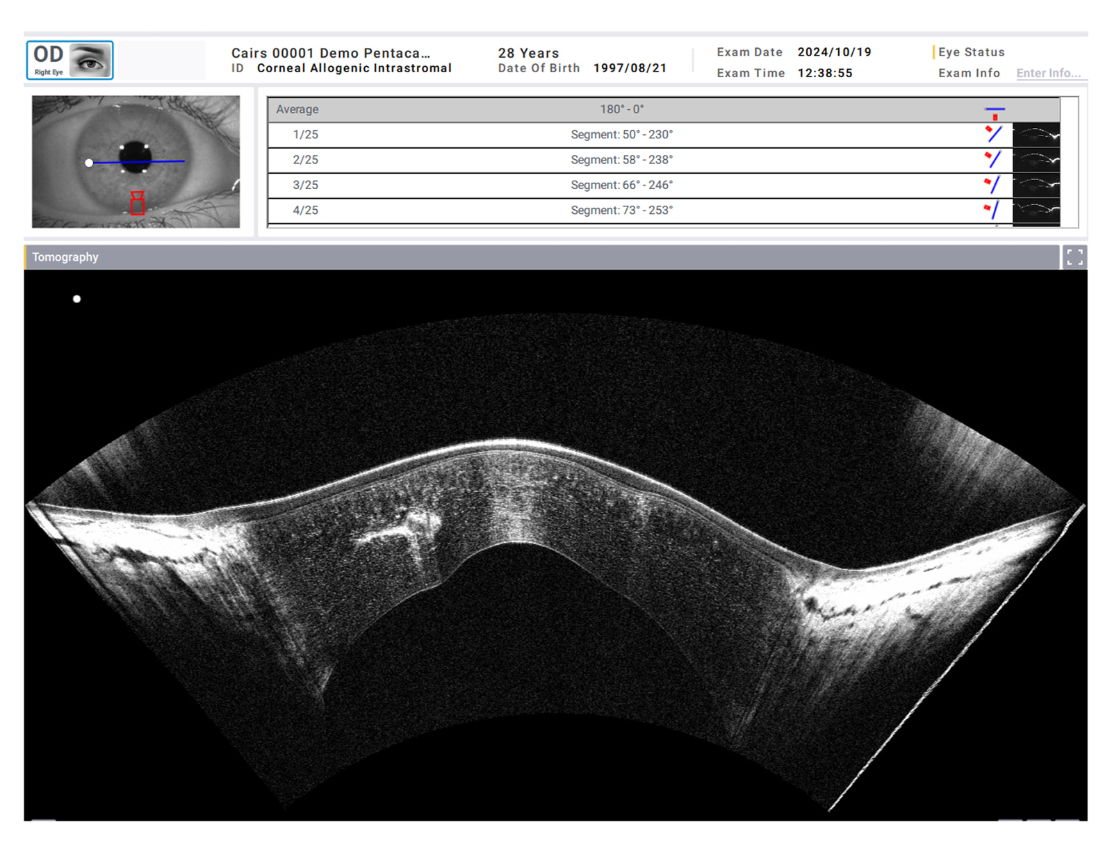 Cornea Zoomモード
