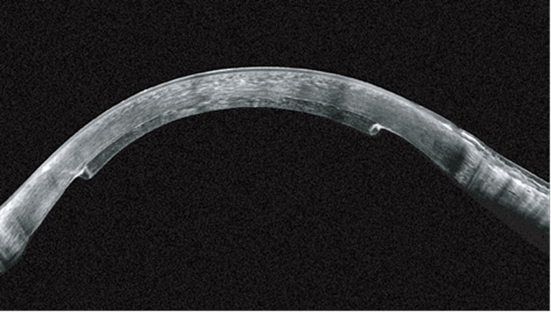 Bスキャン画像とScheimpflug画像との比較