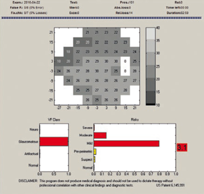 Glaucoma Staging Program(GSP)