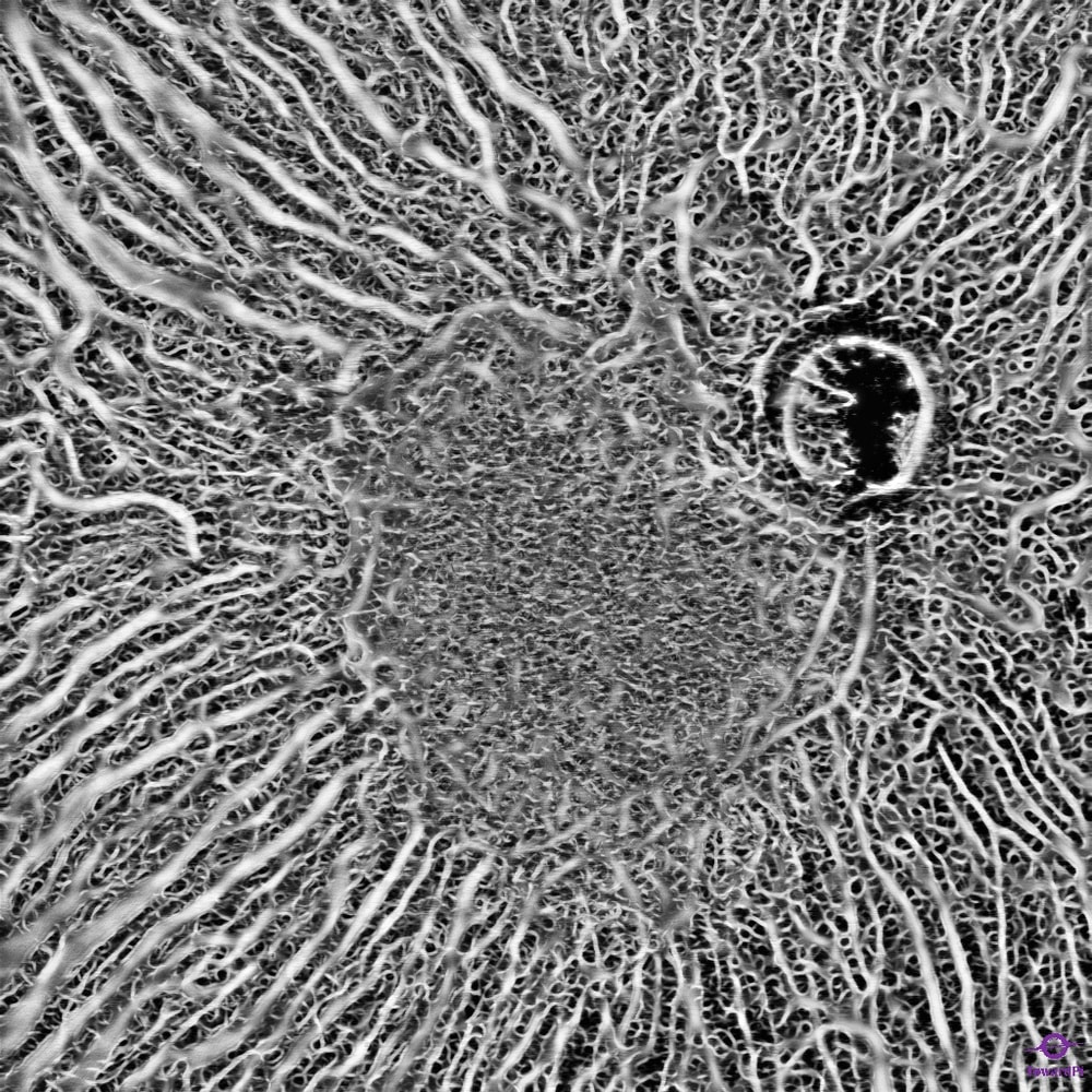 Choroid